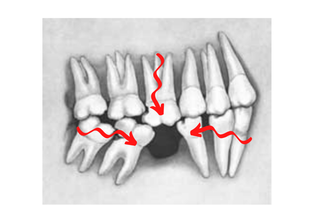 equilibrio della bocca e la tutela degli altri elementi dentali vicini e dei suoi antagonisti